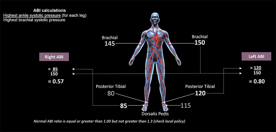 Figure 1: How to calculate the ankle-brachial index